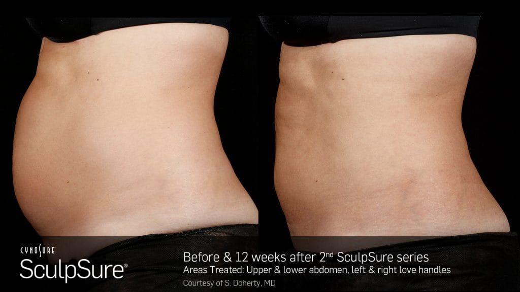 SculpSure before and after photos