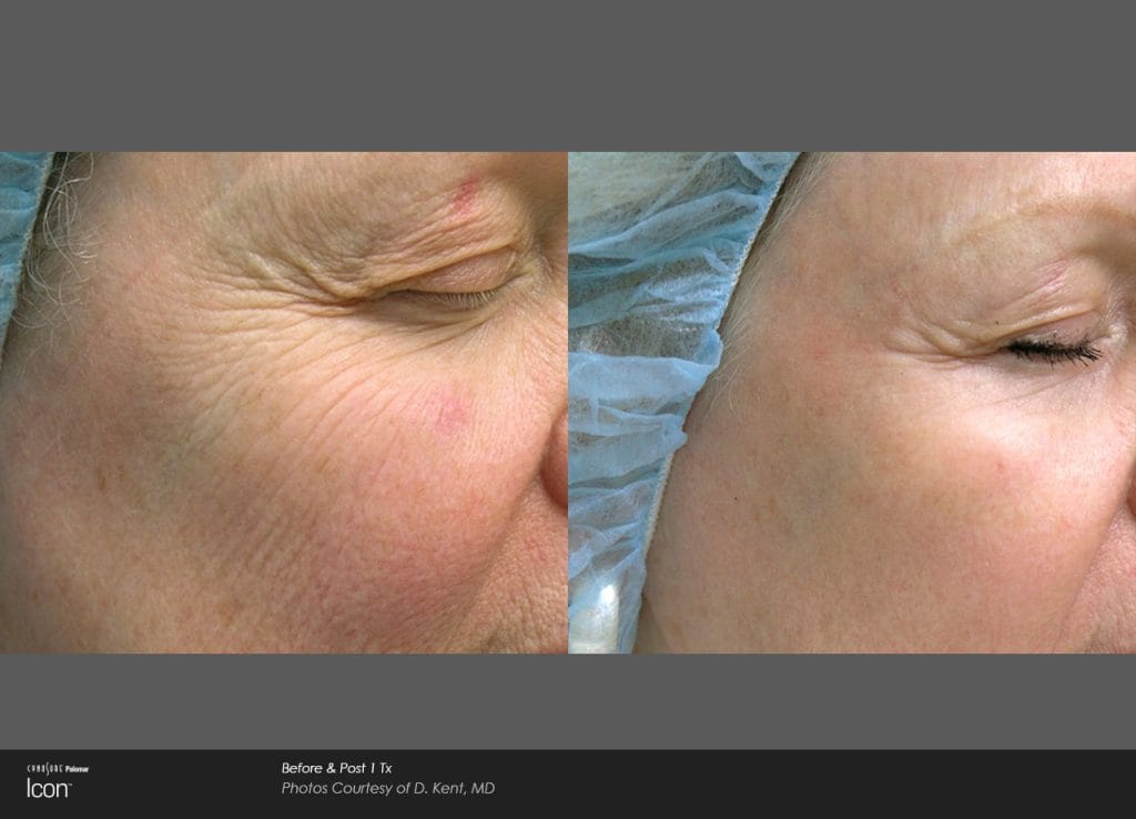 before and after photos for ICON laser treatments