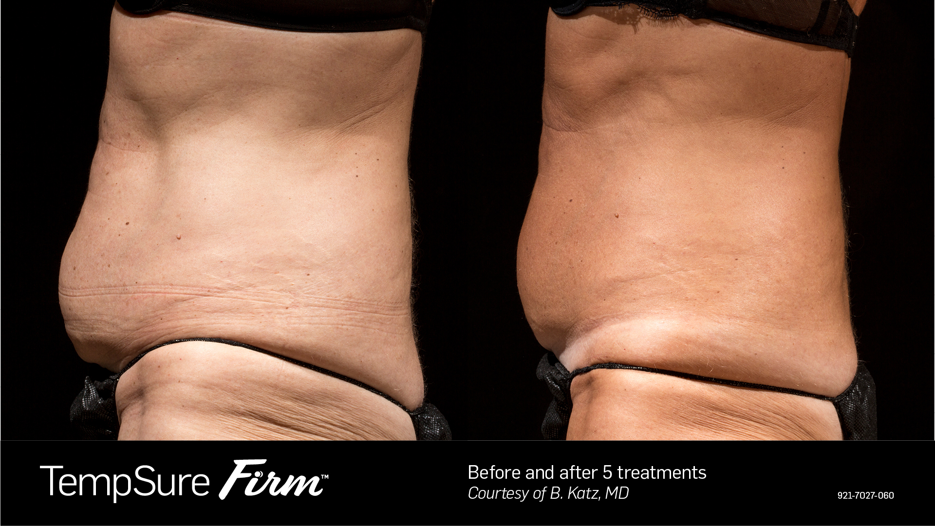 Before and after TempSure Firm results