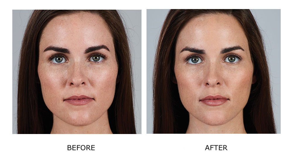 Before and after Juvederm results